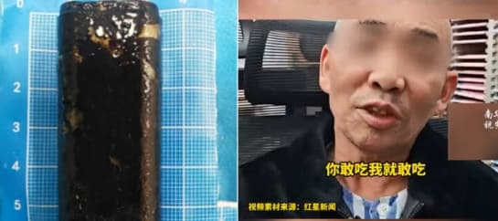 Житель Китая 30 лет прожил с зажигалкой в желудке - она до сих пор работает 